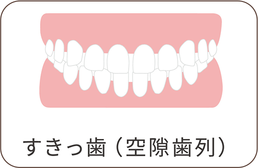 空隙歯列(すきっ歯)